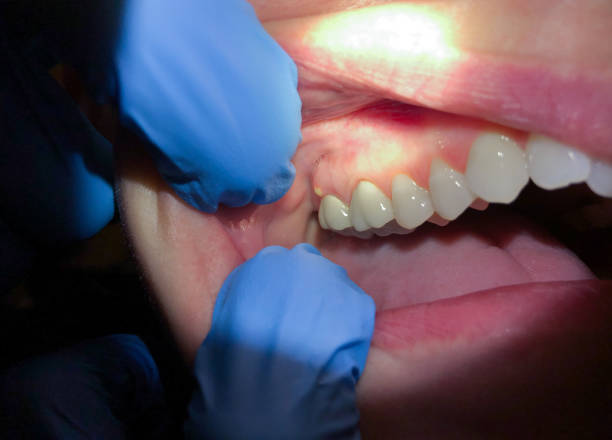 Best Root Canal Emergency Dentist  in Holliday, TX